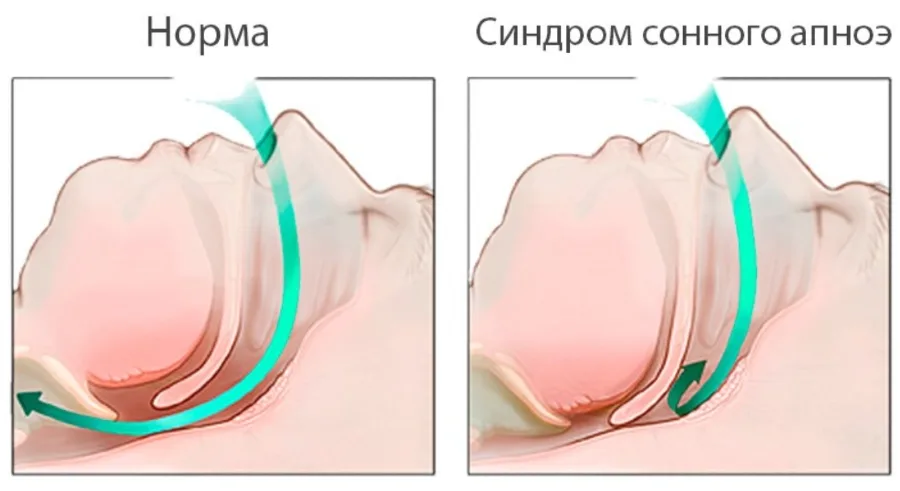 Как лечат апноэ